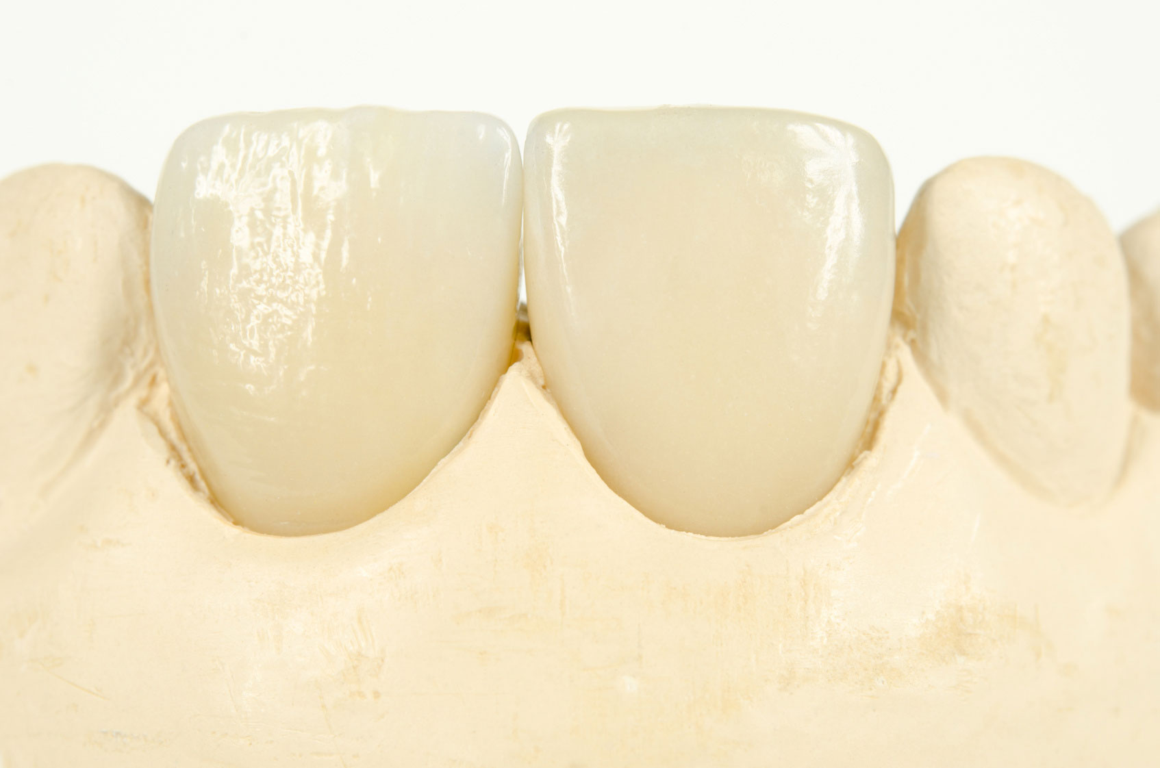 Gipsmodell mit keramischen Frontzähnen