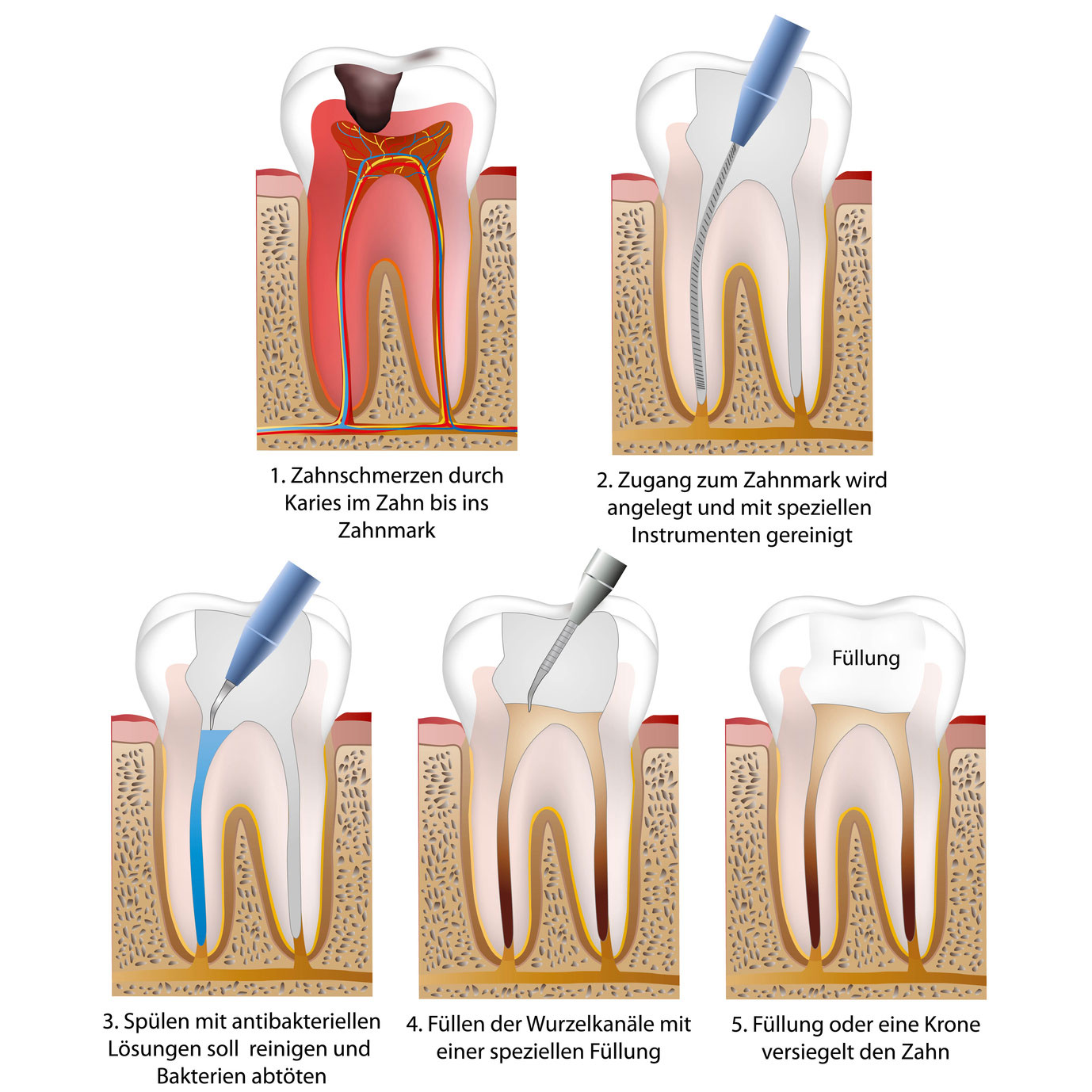 Darstellung einer Wurzelbehandlung
