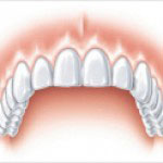 Grafisches Bild eines Oberkiefers